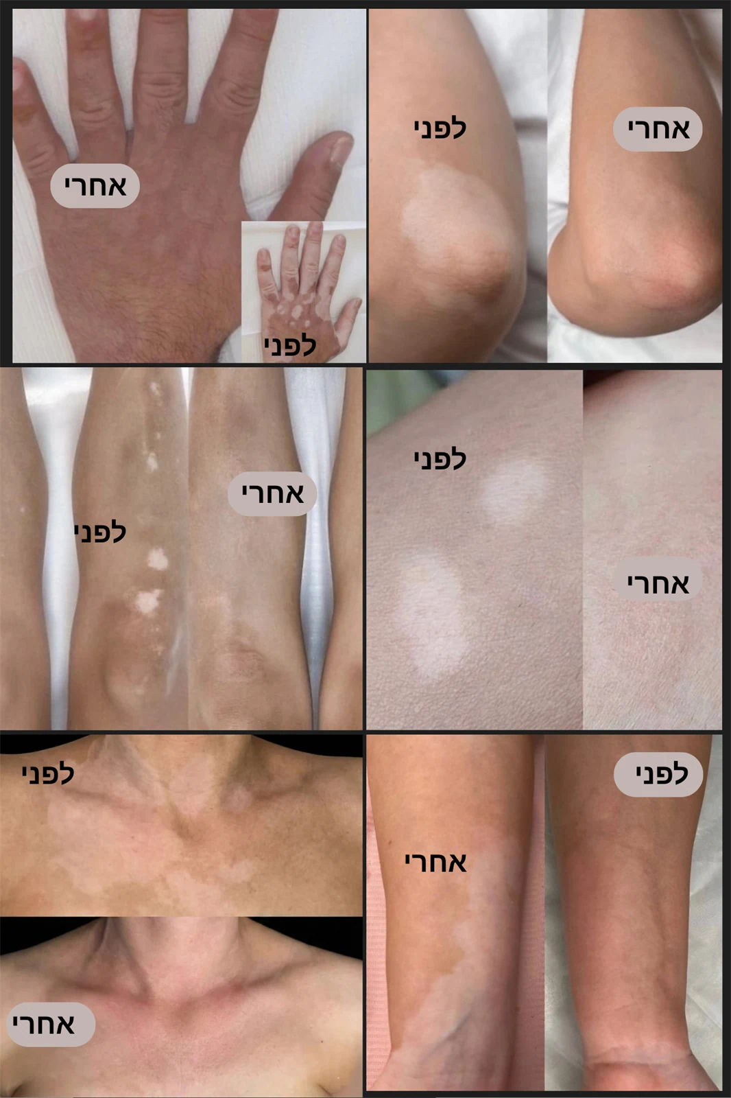 הסוואת צלקות